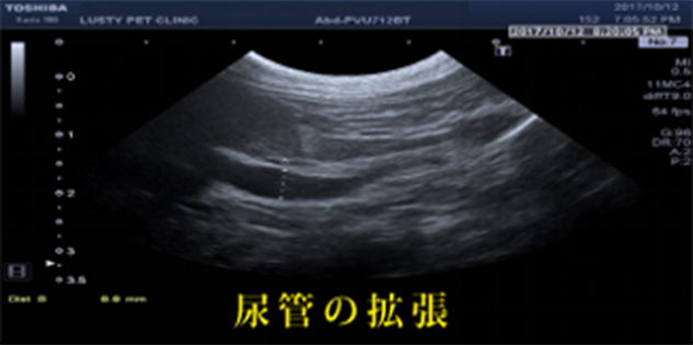 尿管閉塞と腎不全