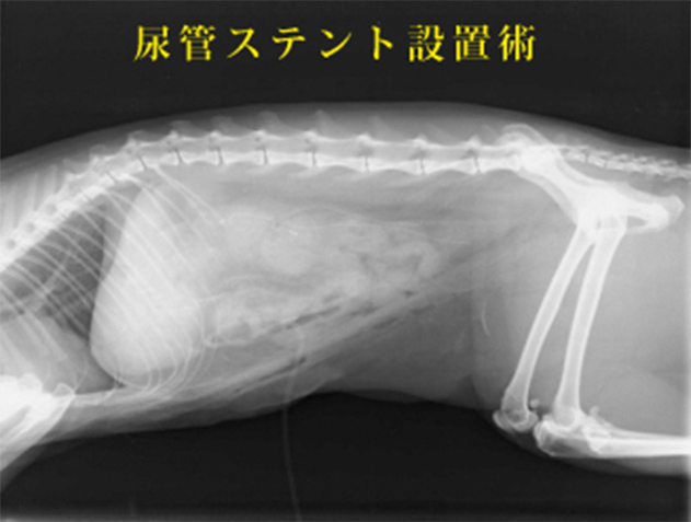 尿管閉塞と腎不全